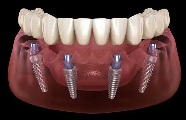 The-best-all-on-4-dental-implants-in-Albania-707x455.jpg